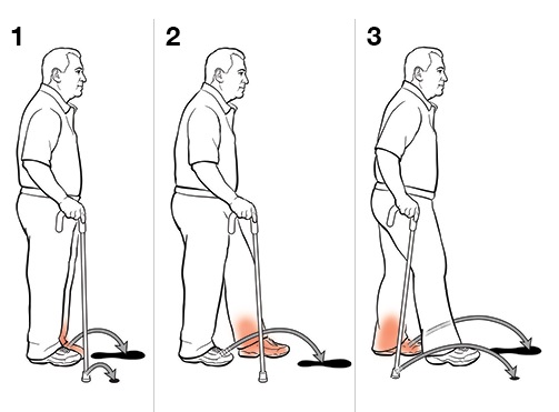 Когда можно ходить после перелома ноги